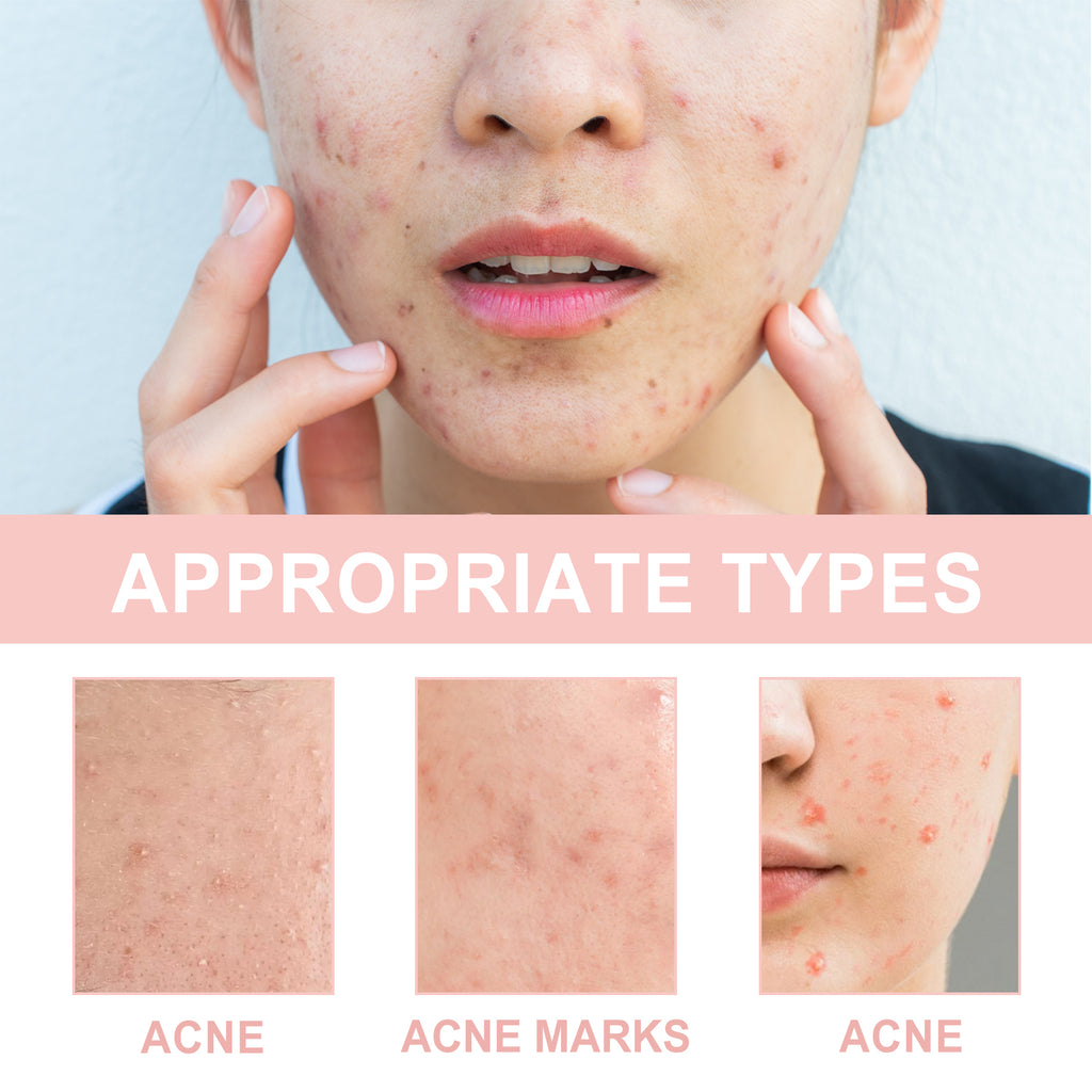 Acne Patch — Pore Cleansing, Blemish Repair & Moisturizing - Health and wellness